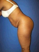 Tummy Tuck (Abdominoplasty) 428737