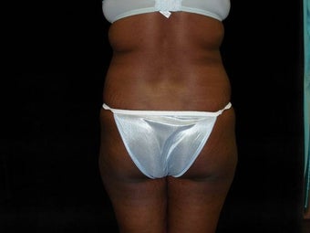 Brazilian Butt Lift before 183430