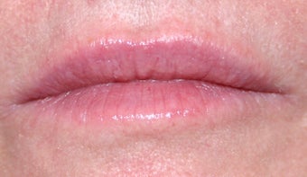 Juvederm and Botox to lips after 240185