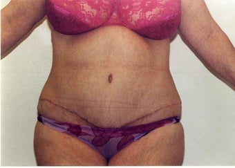 Tummy Tuck after 215129