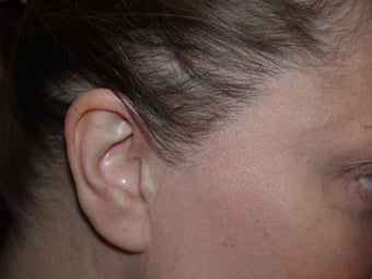 Hair Transplant / 850 grafts to temple after 270701