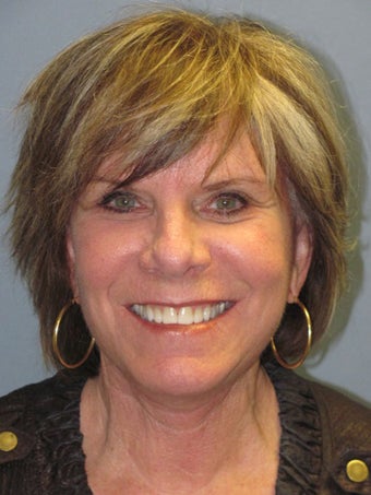 Neck Lift, Platysmaplasty after 634723