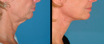 Neck lift and Mini-facelift before 306841