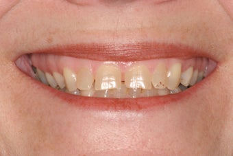Full upper arch of veneers before 244071