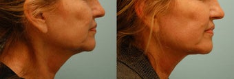 Neck Rejuvenation before 136630