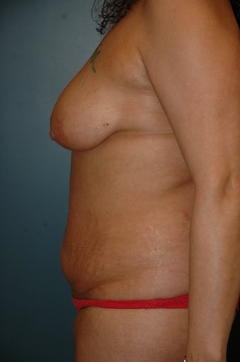 Breast lift and tummy tuck before 238294