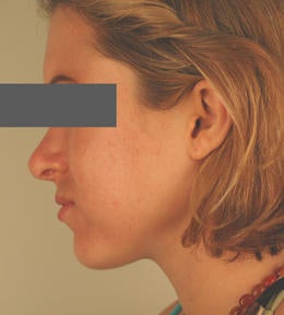 Laser Acne Treatments after 82943