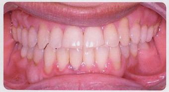 Anterior Crossbite after 353446