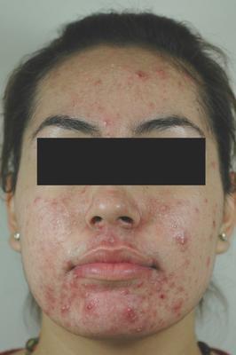 Laser Acne Treatment before 82948