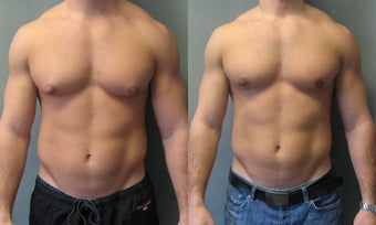 Gynecomastia New York before 349231