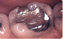 Porcelain onlay before 109476