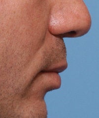Lip Lift 521702