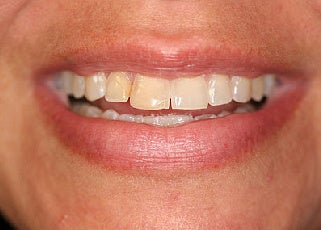 Smile makeover with Lumineers and Invisalign before 109373