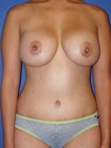 Tummy Tuck Surgery (abdominoplasty) and Breast Implants after 139135