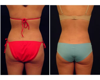 Liposuction before 286656