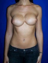 Revision Breast Surgery before 357112