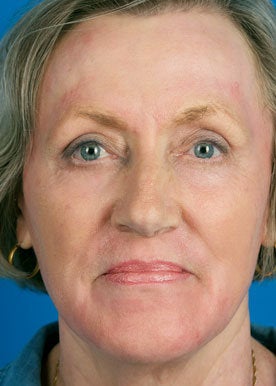 Chemical Peel after 368982