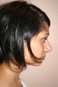 Asian Rhinoplasty after 448668