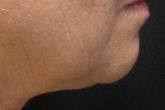 GentleYag treatment for skin tightening after 152215