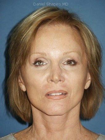 Facelift, Endoscopic Browlift, Upper and Lower Blepharoplasty, Perioral Dermabrasion after 248857