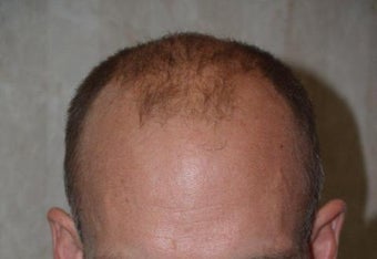 Hair Transplant / 2000 grafts before 222911