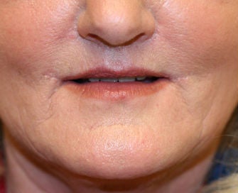Lips after 299910
