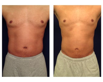Liposuction before 397015