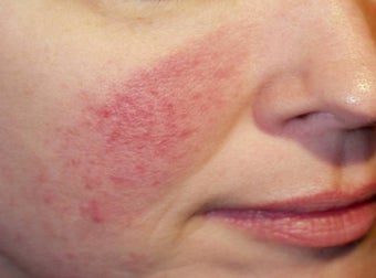 Vein Treatment before 135895
