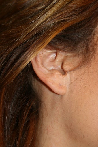 Ear Lobe Repair after 584367