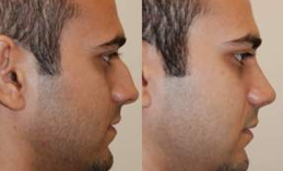 Rhinoplasty. 11 days after surgery. before 119296