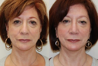 Rhinoplasty Surgery. 6 months post-op before 513908