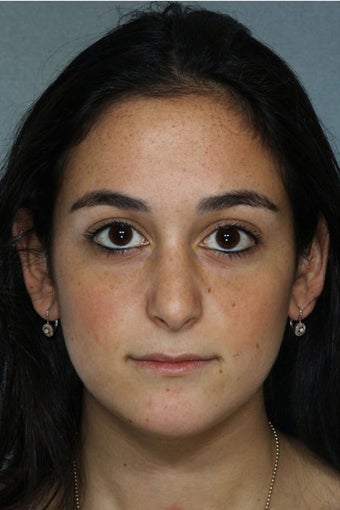 Rhinoplasty after 327037