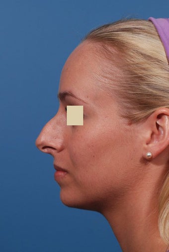 Rhinoplasty Before and After before 146623