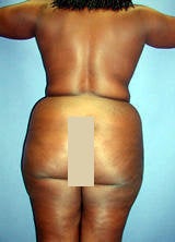 Body Contouring with Liposuction before 133788