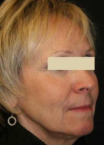 Sculptra after 137154