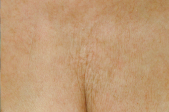 Affirm CO2 to Chest Area after 200600