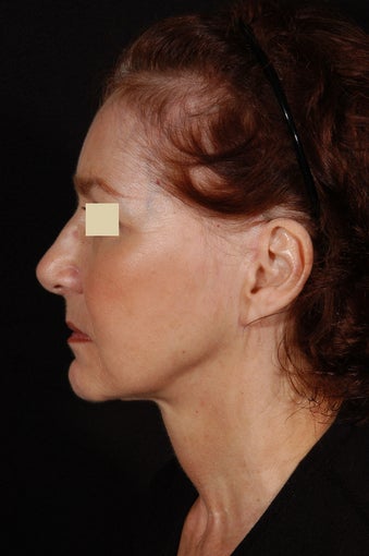 Liposuction of Neck after 155332