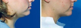 Chin Liposuction before 640743