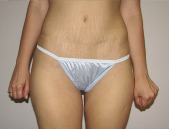 Tummy Tuck after 410415