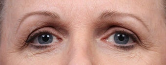 Botox and Dysport before 539897