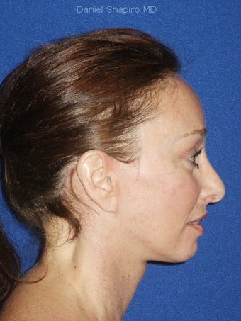 Facelift, Endoscopic Browlift, Upper and Lower Blepharoplasty after 248889