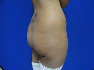 Brazilian Butt Lift before 464058