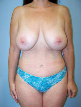Tummy Tuck Surgery (Abdominoplasty) with Breast Augmentation after 121179