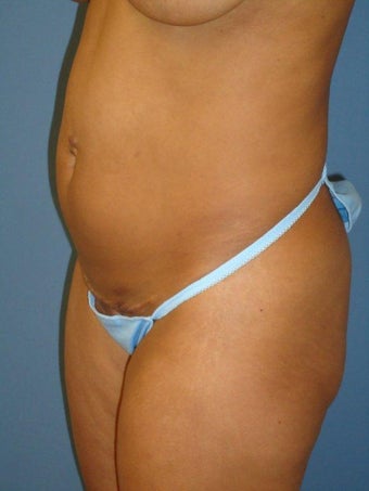 Mini Tummy Tuck before 346173