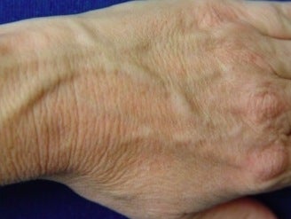 Radiesse hand rejuvenation before 374252