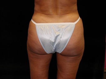 Brazilian Buttocks Lift after 246911