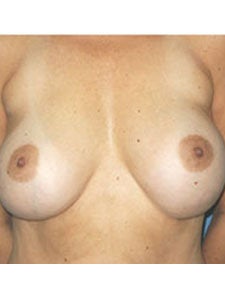 Corrective Breast Imlant Surgery before 250008