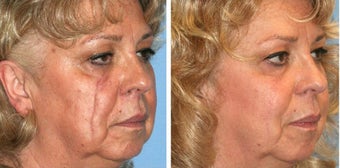 Scar Revision after 493976