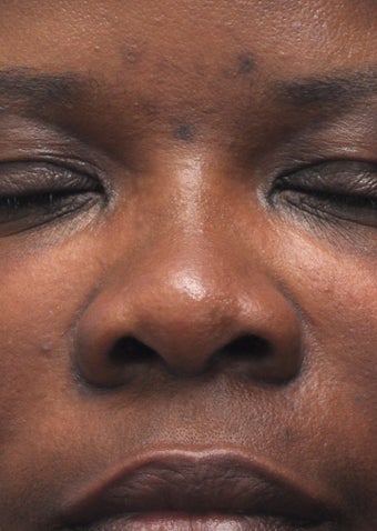 Non Surgical Rhinoplasty before 407865