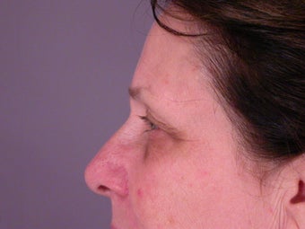 Eyelid Surgery before 306444